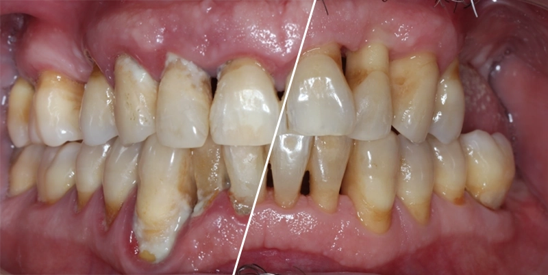 Parodontologie — Avant / Après
