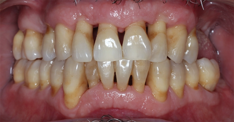 Après traitement parodontal