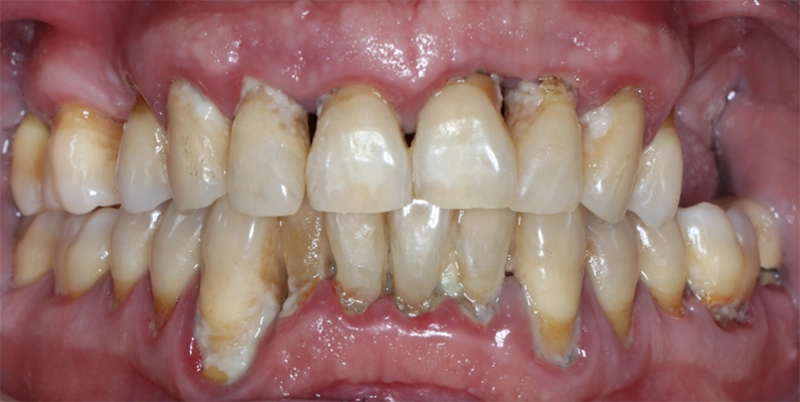 Avant traitement parodontal